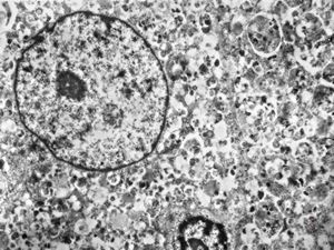 F,1y. | epulis congenitalis (granulomatosa) F,1y. | epulis congenitalis (granulomatosa)